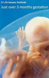 Photo: image of typical 14-week baby. 